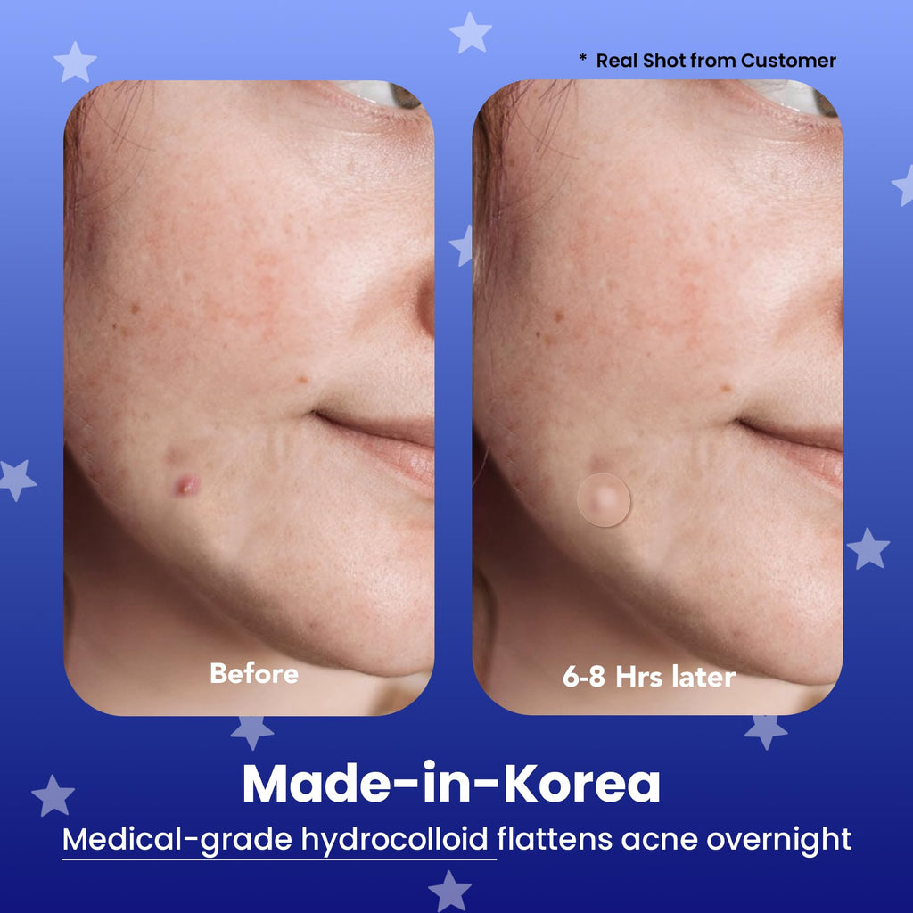 AVARELLE Spot Pimple Patches for Face | Good Night Acne Cover | Hydrocolloid with Tea Tree Oil | Acne Spot Treatment (12-14 mm, 96 ct)
