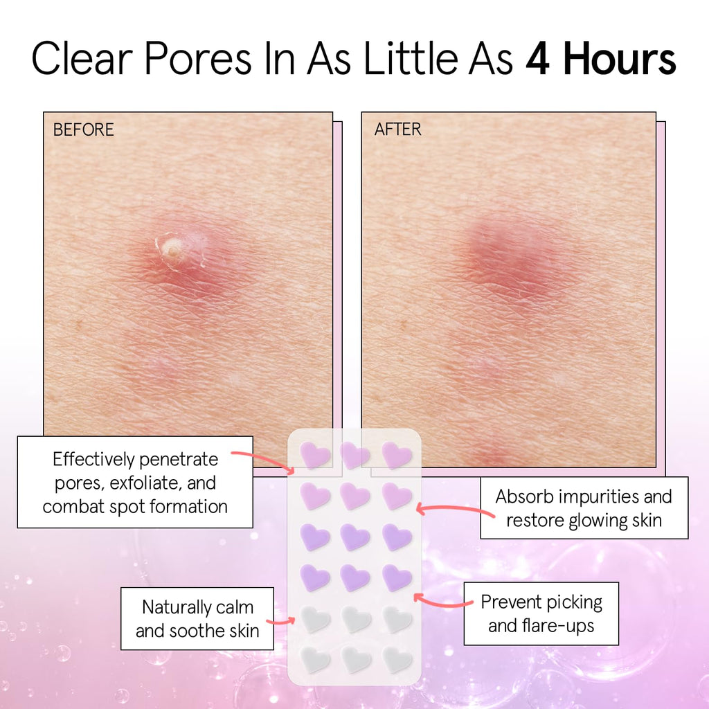 grace & stella Award Winning Pimple Patches for Face - Dermatologist Tested Acne Patches - Hydrocolloid Patch for Breakouts, Whiteheads - Vegan Acne Spot Treatment for Face (Hearts, 216 Pack)