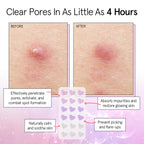 grace & stella Award Winning Pimple Patches for Face - Dermatologist Tested Acne Patches - Hydrocolloid Patch for Breakouts, Whiteheads - Vegan Acne Spot Treatment for Face (Hearts, 216 Pack)