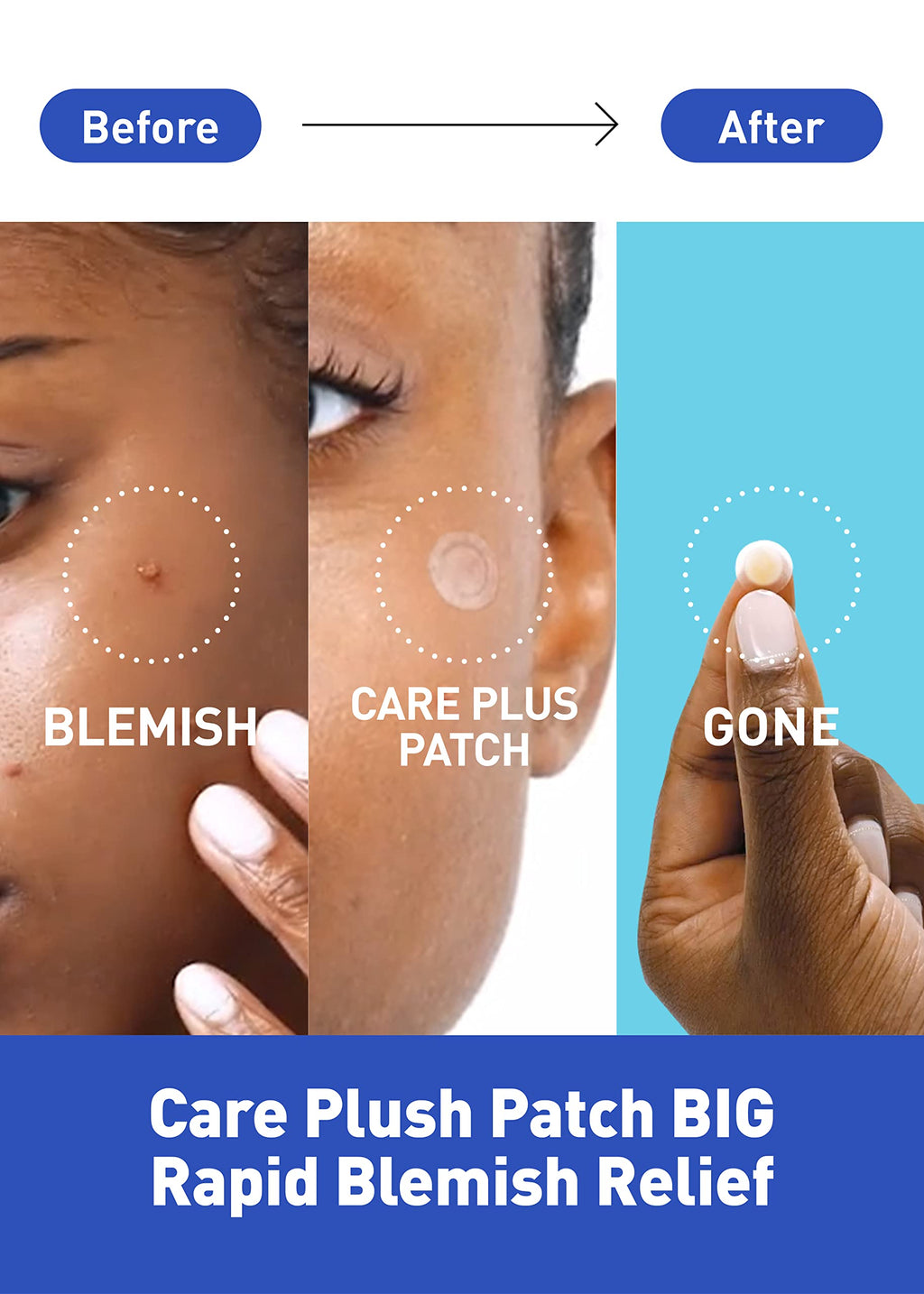 OLIVE YOUNG Care Plus Spot Patch | Hydrocolloid Acne Korean Spot Patch to Cover Zits, Pimples and Blemishes, for Troubled Skin and Face (Hydrocolloid, 204 Count (Pack of 2))
