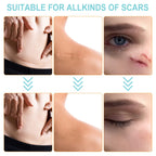 Silicone Scar Sheets,Silicone Scar Tape Roll,Medical Grade Silicone Tape for Scar Removal,Professional Scar Treatment Patch for C-Section,Keloids,Surgical,Acne (Roll Size 1.6''x150''-3.8M)