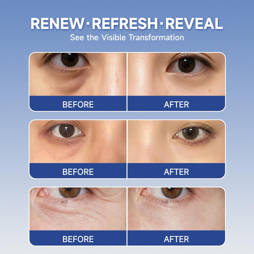 4 pairs PDRN & Calcium Micro Eye Patches, Under Eye Patches for Puffy eyes, Dark Circles & Wrinkle | Hyaluronic Acid, Kojic Acid, Collagen, Peptides, Vitamin C, Niacinamide - Korean Popular Eye Care