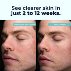 VitaMedica Clear Skin Vitamin Formula | Noncystic Acne Supplement for Skin Clearing | Clear Complexion for Women and Men | Vitamins A, C, E, Selenium, Chromium, and Zinc for Skin Health | 60 Count
