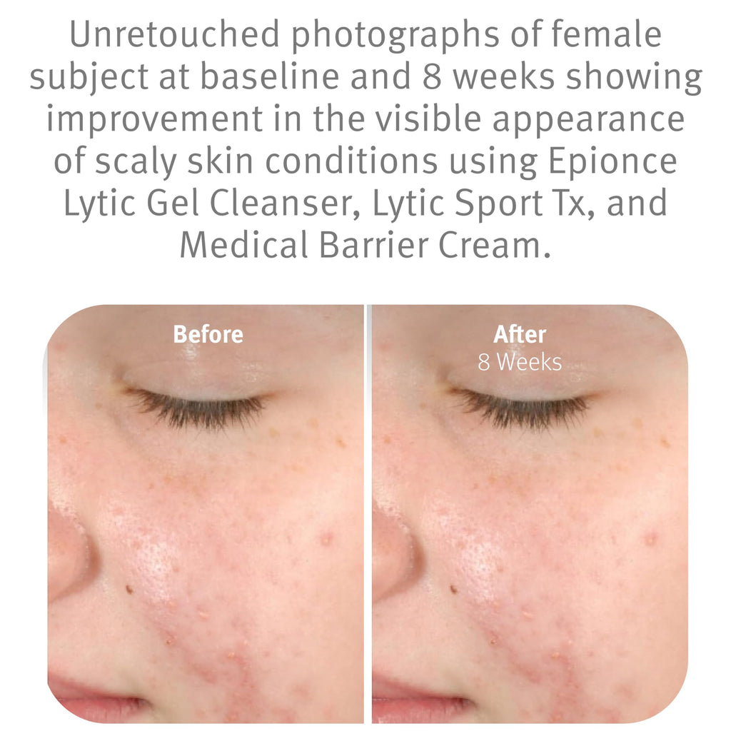 Epionce Lytic Gel Cleanser – Gentle Foaming Face Wash & Makeup Remover | For Oily, Combination & Problem Skin | Acne & Oil-Control Cleanser with Willow Bark | Dermatologist Skincare