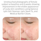 Epionce Lytic Gel Cleanser – Gentle Foaming Face Wash & Makeup Remover | For Oily, Combination & Problem Skin | Acne & Oil-Control Cleanser with Willow Bark | Dermatologist Skincare