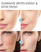 Dark Spot Remover for Face and Body: Hyperpigmentation Treatment - Natural Ingredient - Freckle/Melasma/Sun Spot/Age Spot Remover - Dark Spot Corrector Cream for Women and Men