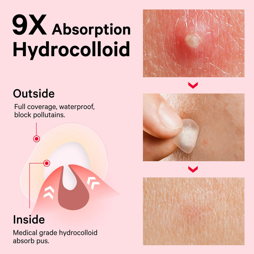 Sosky Pimple Patches for Face, FSA HSA Eligible Invisible Hydrocolloid Acne Patches, Zit Sticker for Face and Skin, Pimple Sticker for Covering Zits, Blemishes with Salicylic Acid 144 Count