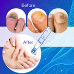 Fungal Nail Pen, Toenail Fungus Pen, Nail fungus treatment For Toenails & Fingernails to Repair Nails by Fungi - 3 Pcs