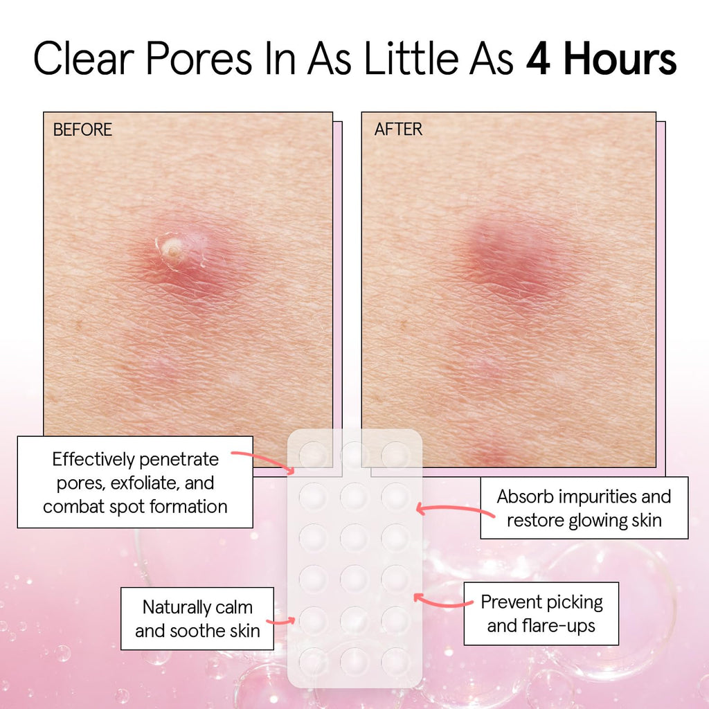 grace & stella Award Winning Pimple Patches for Face - Dermatologist Tested Acne Patches - Hydrocolloid Patch for Breakouts, Whiteheads - Vegan Acne Spot Treatment for Face (Invisible, 144 Count)