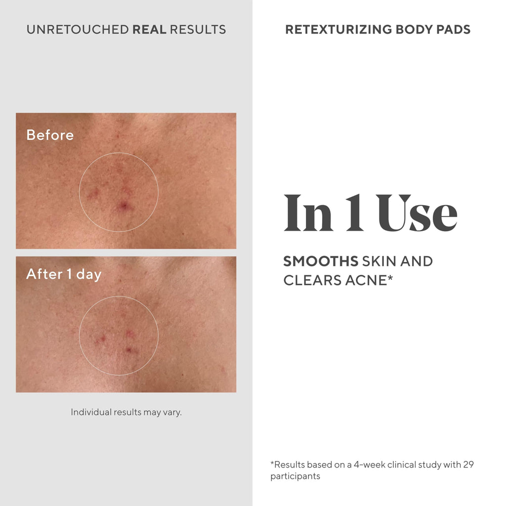 Murad Retexturizing Body Pads – Acne-Fighting Exfoliating Pads with Azelaic, Salicylic, and Glycolic Acid for Acne Breakouts, Smoothing KP Bumps, and Soothing Aggravated Skin – 45 Pads
