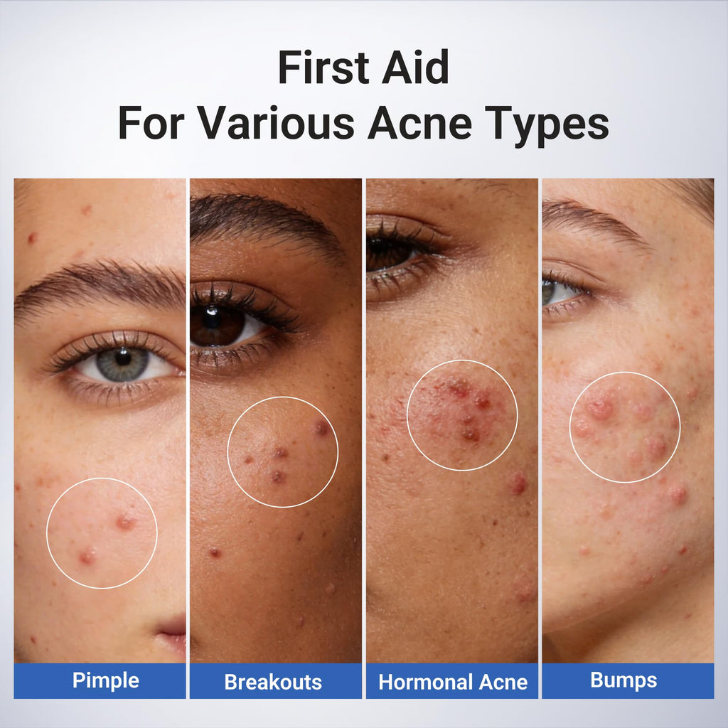 Dr.Leo 1.8% Salicylic Acid Spot Serum, Acne Treatment for Acne-Prone Sensitive Skin | Niacinamide, Fast Pimple Relief, Fades Acne Marks, Overnight & Period Breakouts, 0.34 fl oz (20 ml)