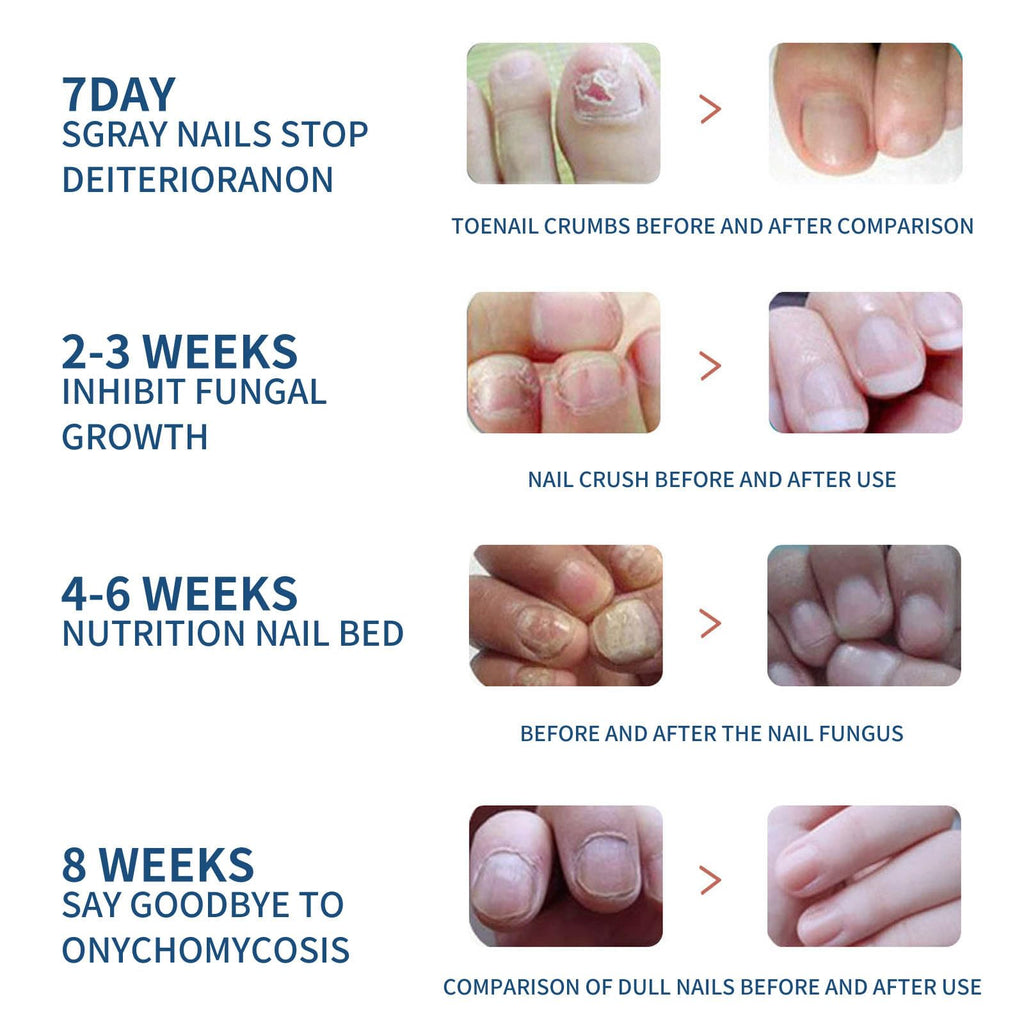 64PCS Fungal Nail Patches, Fungal Nail Treatment for Toenails Extra Strong, Fast-Acting Nail Fungal Treatment Patches for Damaged & Thick Nails, Overnight Repair & Long-Lasting Relief