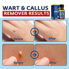 MEOLY Fast-Acting Wart Remover: Salicylic Acid Wart Remover for Plantar Wart, Corn Fast-Acting for Men and Women 30 ML
