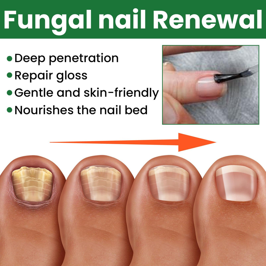 Ginger Toenail Fungus Treatment, Fungal Nail Treatment, Ginger Nail Growth Serum,7 Days Nail Treatment, Antifungal Nail Repair Serum, Fast-Acting Recovery for Thick, Discolored, Yellow Nails