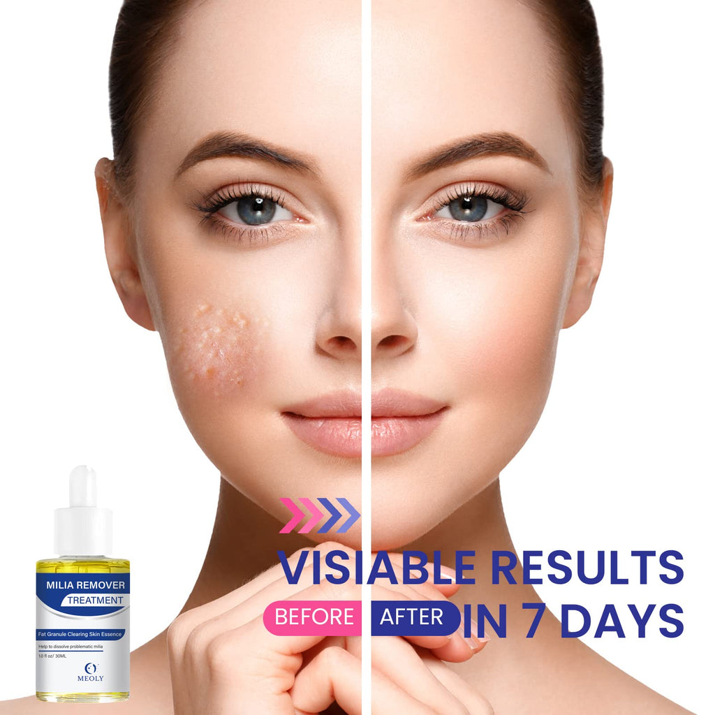 Milia Remover, Milia Spot Treatment Helps Dissolve and Reduce Milia, Whitehead, and Sebaceous Hyperplasia New Formula 30 ML