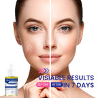 Milia Remover, Milia Spot Treatment Helps Dissolve and Reduce Milia, Whitehead, and Sebaceous Hyperplasia New Formula 30 ML