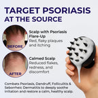 Psoriasis Shampoo Anti Dandruff - Medicated shampoo for Dandruff, Flakes, Seborrheic Dermatitis & Folliculitis Treatment - Anti Fungal Solution for Itchy, Flaky & Dry Scalp - 200ml