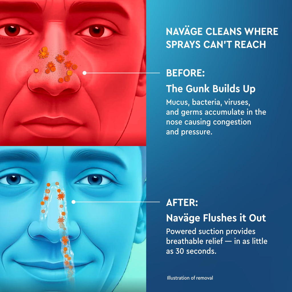 Navage® Nasal Irrigation System Deluxe Bundle, Nose Cleaner for Congestion Relief w/ 30 SaltPods, Storage Caddy, Black Travel Bag & Batteries ($137 Value). Sinus Rinse for Clinically Proven Benefits