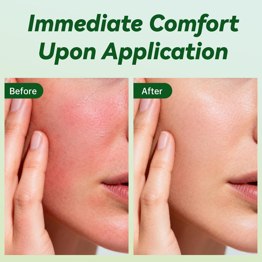 ULARCS Triamicinolona Non-Irritating Cream 0.1%, For All Skin Types, 30g