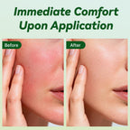 ULARCS Triamicinolona Non-Irritating Cream 0.1%, For All Skin Types, 30g