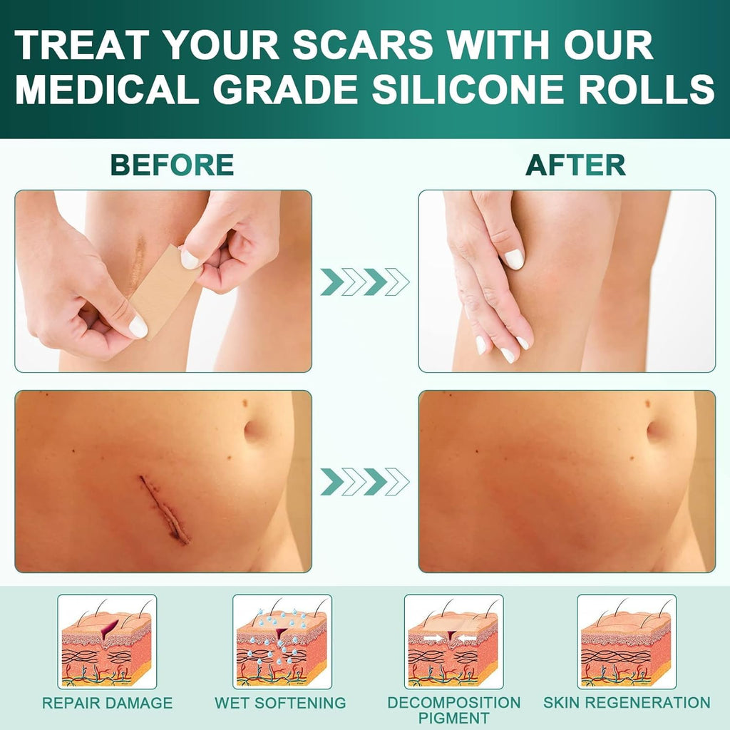 Silicone Scar Sheets,Silicone Scar Tape(1.6"x 120" Roll-3M), Reusable and Effective Scar Removal Sheets, Silicone Scar Removal Sheets for Surgical Scars,Healing Keloid, C-Section, Tummy Tuck