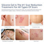 100% Silicone Scar Gel Scars Cream - Advanced Scar Gel for Surgical Scars, C-Section, Stretch Marks, Acne, Injury, Burns, Keloids, Old and New Scars 1.06oz(30g) (Maximum Strength 100% Silicone)