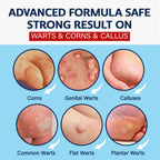 MEOLY Fast-Acting Wart Remover: Salicylic Acid Wart Remover for Plantar Wart, Corn Fast-Acting for Men and Women 30 ML