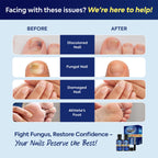Toenail Fungus Treatment with 25% Undecylenic Acid, Toe Fungus Treatment for Toenail, Fungus Nail Treatment, Toenail Fungus Treatment Extra Strength, Fungal Nail Treatment for Athletes Foot - 2pcs