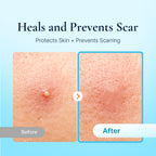 DERMAKR Discreet Acne Pimple Patch | Spot Cover & Treatment Solution Cystic Acne & Pimple | Hydrocolloid Facial Stickers | Waterproof Patches Invisibly Cover Pimples (4packs)