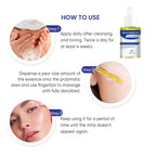 Milia Remover, Milia Spot Treatment Helps Dissolve and Reduce Milia, Whitehead, and Sebaceous Hyperplasia New Formula 30 ML