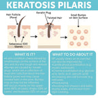 KP Bump Eraser Body Set with 10% AHA | Keratosis Pilaris Treatment | Keratosis Pilaris Lotion | Exfoliating Body Scrub | Ingrown Hair Treatment | Bundle Set for Bump, Strawberry Legs, Redness, Dryness