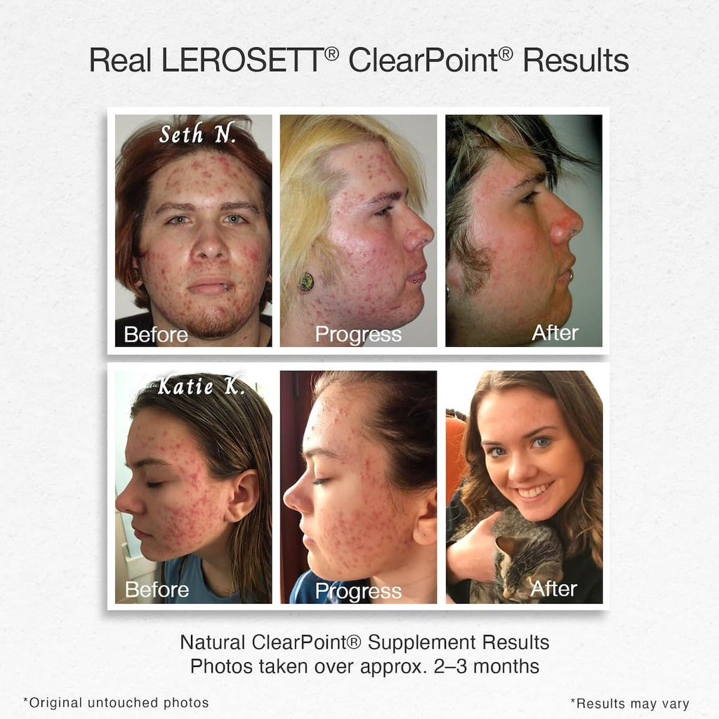Gunilla Of Sweden LEROSETT ClearPoint Anti Acne Pills, Natural Supplements for Acne Treatment for Oily Skin & Breakouts. 60 Caps
