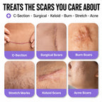 Silicone Scar Tape — Medical-Grade, 1.6" x 60", Cut-to-Fit for C-Section, Surgical & Keloid Scars, Face & Wrinkles | Reusable