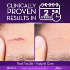 Cicatricure Advanced Scar Gel for Face & Body - Proven Results in 2 Weeks, Scar Treatment for Surgical Scars, Stretch Marks, Scars of Burns and Injuries, Acne Scar Treatment, 1 oz (28 g) - Pack of 3