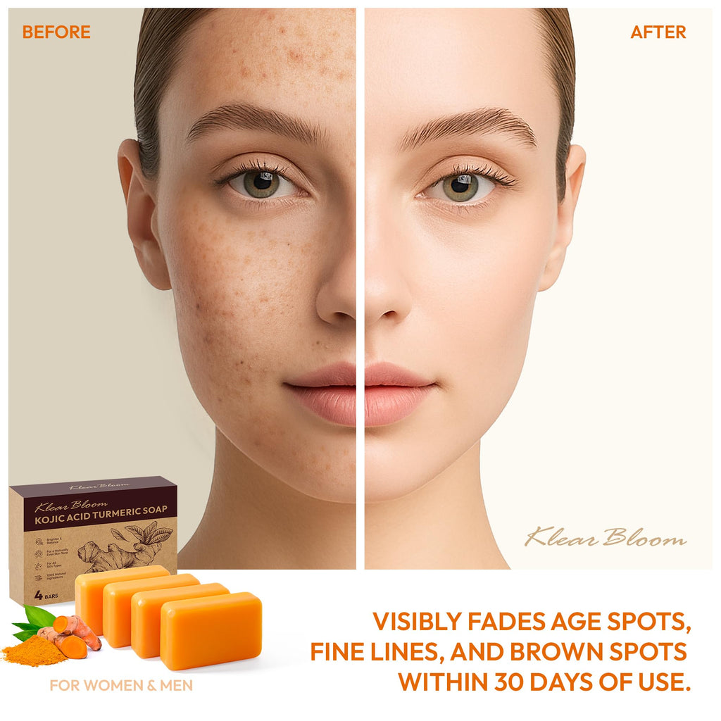 KlearBloom Kojic Acid Soap, Turmeric Soap Bar for Dark Spots Brightening & Moisturizing with Collagen, Vitamin E, Retinol, Hyaluronic Acid, Shea Butter, Paraben & Sulfate-Free 105g x4 Bars