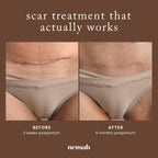 Nemah Restorative Scar Treatment, C Section Recovery, Scar Cream for Surgical Scars, Ideal to Reduce the C Section and Acne Marks, Dermatologist Approved, Antioxidant Rich, Vegan Formula, 1 oz