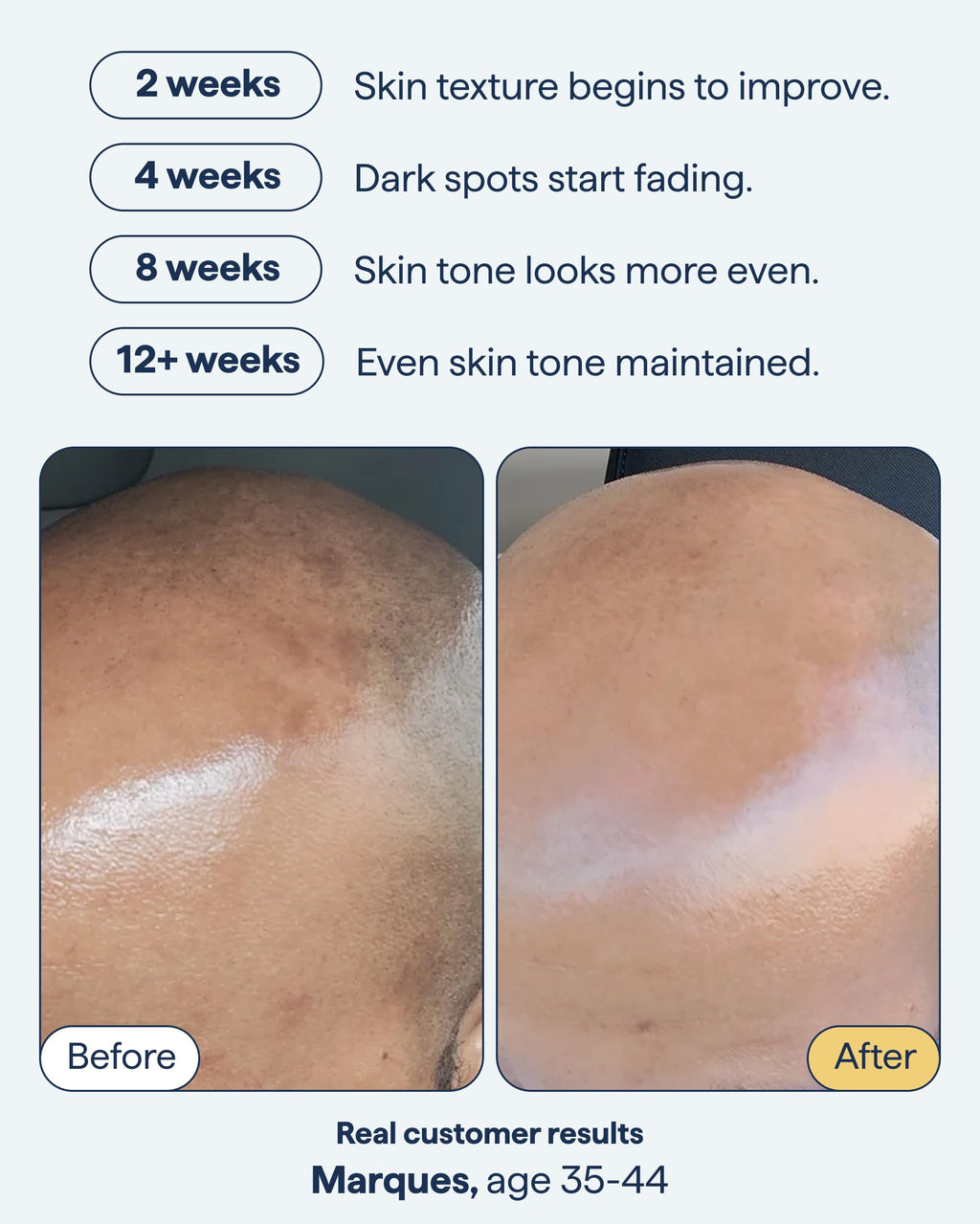 Remedy for Dark Spots | Advanced Night Treatment with Retinol & Kojic Acid | For Discoloration and Uneven Tones | With Glutathione, Niacinamide, Mandelic Acid | By Dermatologist Dr. Shah, 1 fl. oz