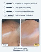 Remedy for Dark Spots | Advanced Night Treatment with Retinol & Kojic Acid | For Discoloration and Uneven Tones | With Glutathione, Niacinamide, Mandelic Acid | By Dermatologist Dr. Shah, 1 fl. oz