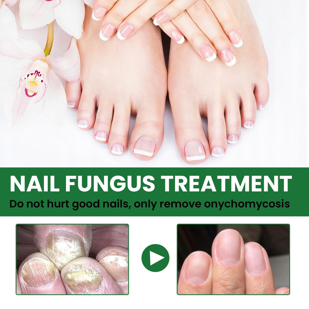 Ginger Toenail Fungus Treatment, Fungal Nail Treatment, Ginger Nail Growth Serum,7 Days Nail Treatment, Antifungal Nail Repair Serum, Fast-Acting Recovery for Thick, Discolored, Yellow Nails