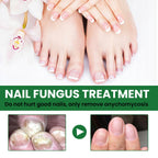 Ginger Toenail Fungus Treatment, Fungal Nail Treatment, Ginger Nail Growth Serum,7 Days Nail Treatment, Antifungal Nail Repair Serum, Fast-Acting Recovery for Thick, Discolored, Yellow Nails