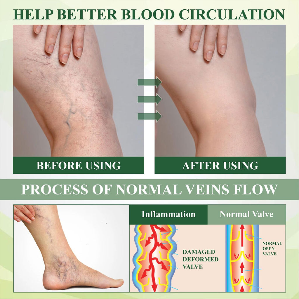 Fluidease Leg Therapy Edema Cream, Fluid Ease Leg Therapy Cream, Lymphatic Drainage Massage Cream, Swell Care Lymphatic Massage Cream, Edema Relief for Legs and Feet (1)