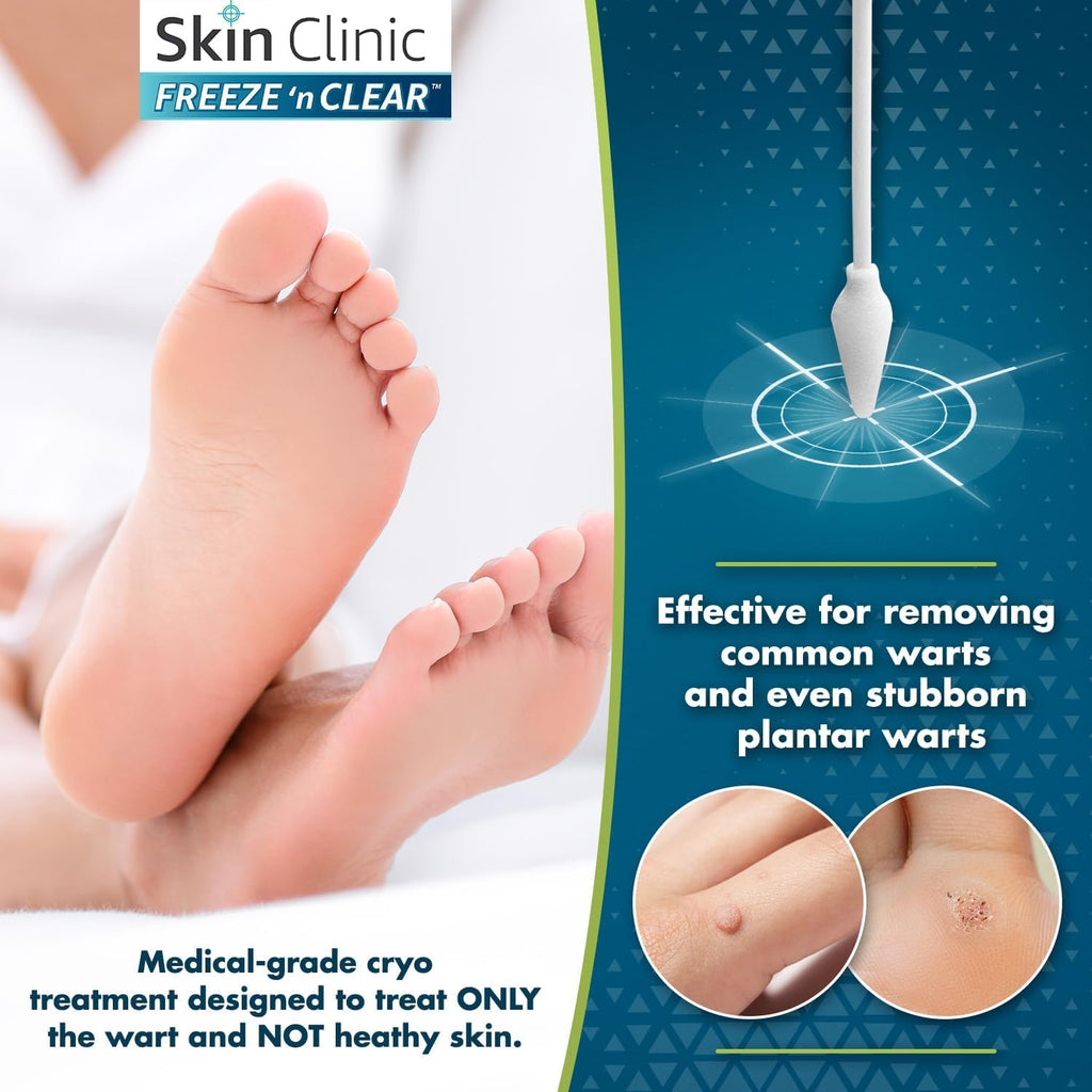 Skin Clinic Freeze 'n Clear Advanced Wart Remover - USA Made Cryo-Freeze Kit with 12 Precision-Tip Applicators - FDA-Cleared Freezing Wart Treatment Solution for Adults & Kids 4+
