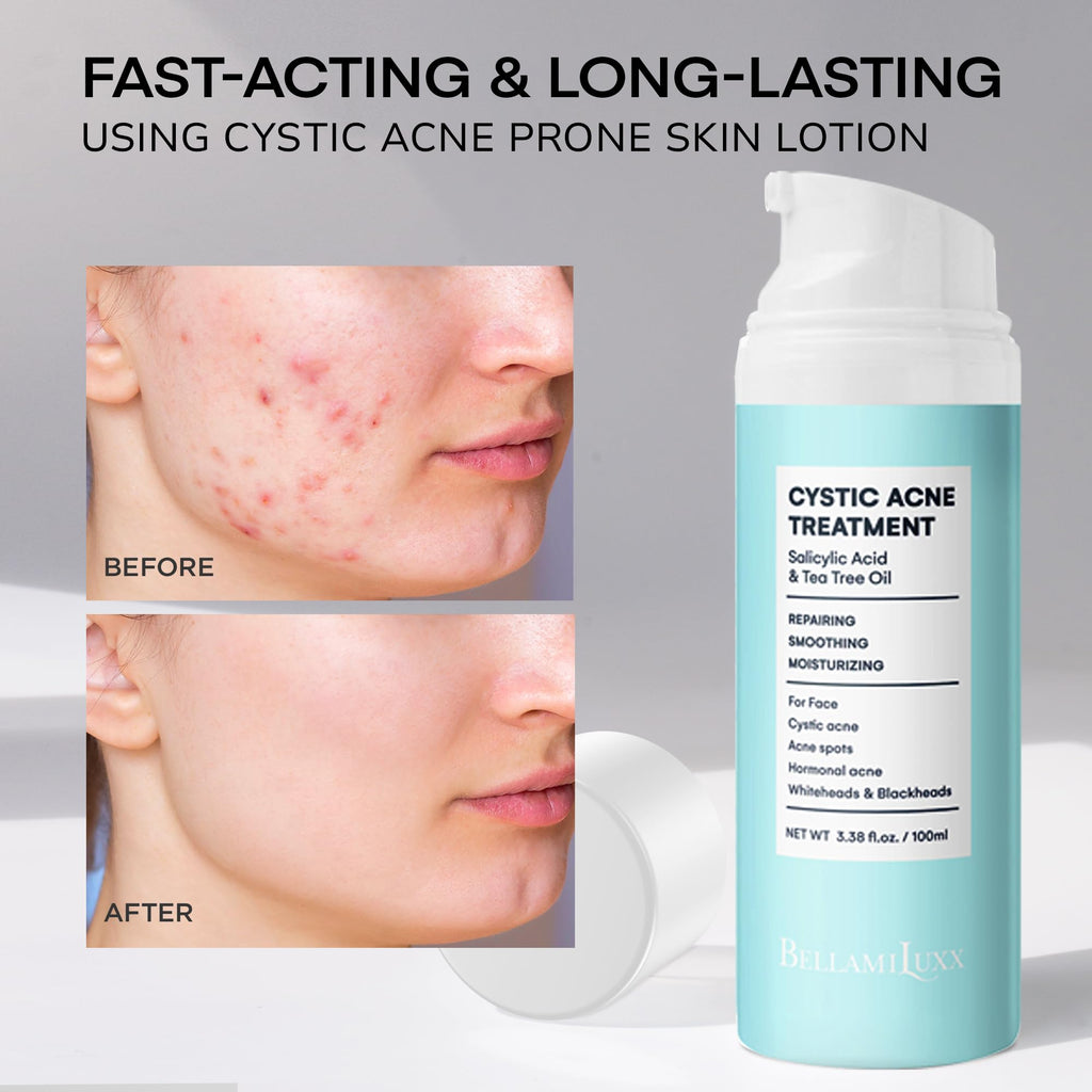 Cystic Acne Spot Treatment for Face: Hormonal Acne Pimple Cream with Salicylic Acid & Tea Tree Oil - Hormonal & Pimple Cream for Teens & Adults,120 Day Supply & 3.38 oz / 100 ml
