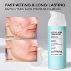 Cystic Acne Spot Treatment for Face: Hormonal Acne Pimple Cream with Salicylic Acid & Tea Tree Oil - Hormonal & Pimple Cream for Teens & Adults,120 Day Supply & 3.38 oz / 100 ml