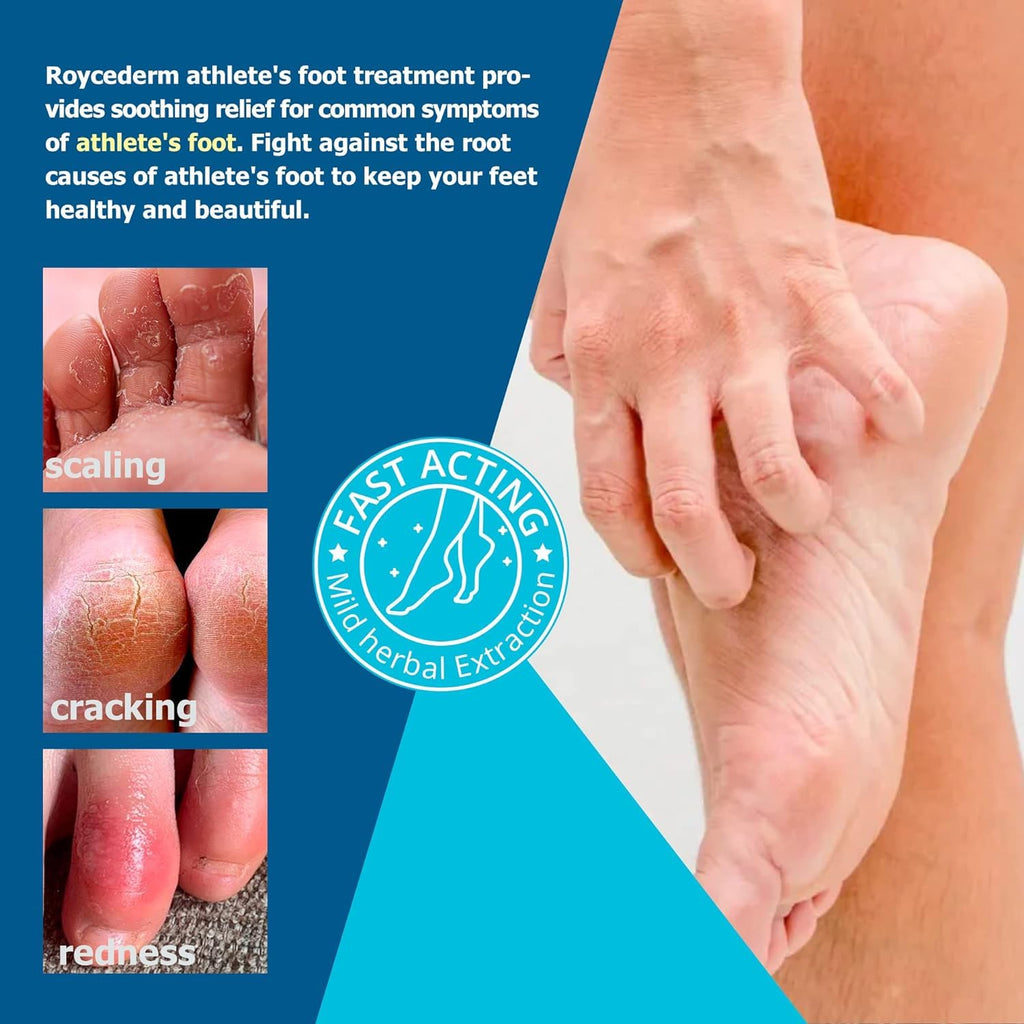 Roycederm Extra Strength Athletes Foot Treatment Cream, Powerful Relief for Itching and Burning, Suitable for Men and Women