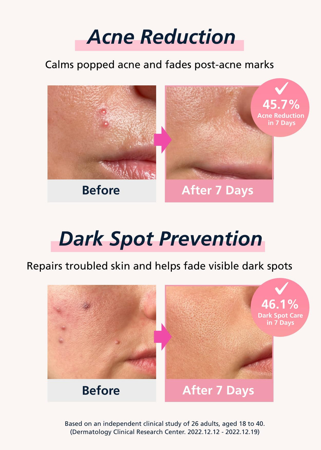 Easyderm Real Calming Patch Microdart Pimple Patches, Clear Nano Micropoint | Niacinamide, Hyaluronic Acid, EGF Acne Dark Spot Care, K-beauty | 12 Counts