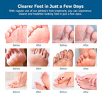 Roycederm Extra Strength Athletes Foot Treatment Cream, Powerful Relief for Itching and Burning, Suitable for Men and Women