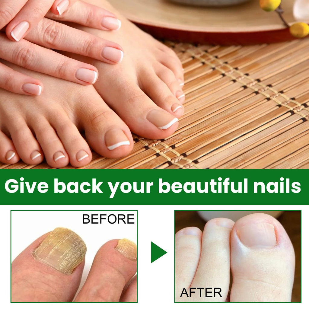 Ginger Toenail Fungus Treatment, Fungal Nail Treatment, Ginger Nail Growth Serum,7 Days Nail Treatment, Antifungal Nail Repair Serum, Fast-Acting Recovery for Thick, Discolored, Yellow Nails