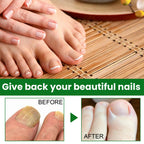 Ginger Toenail Fungus Treatment, Fungal Nail Treatment, Ginger Nail Growth Serum,7 Days Nail Treatment, Antifungal Nail Repair Serum, Fast-Acting Recovery for Thick, Discolored, Yellow Nails