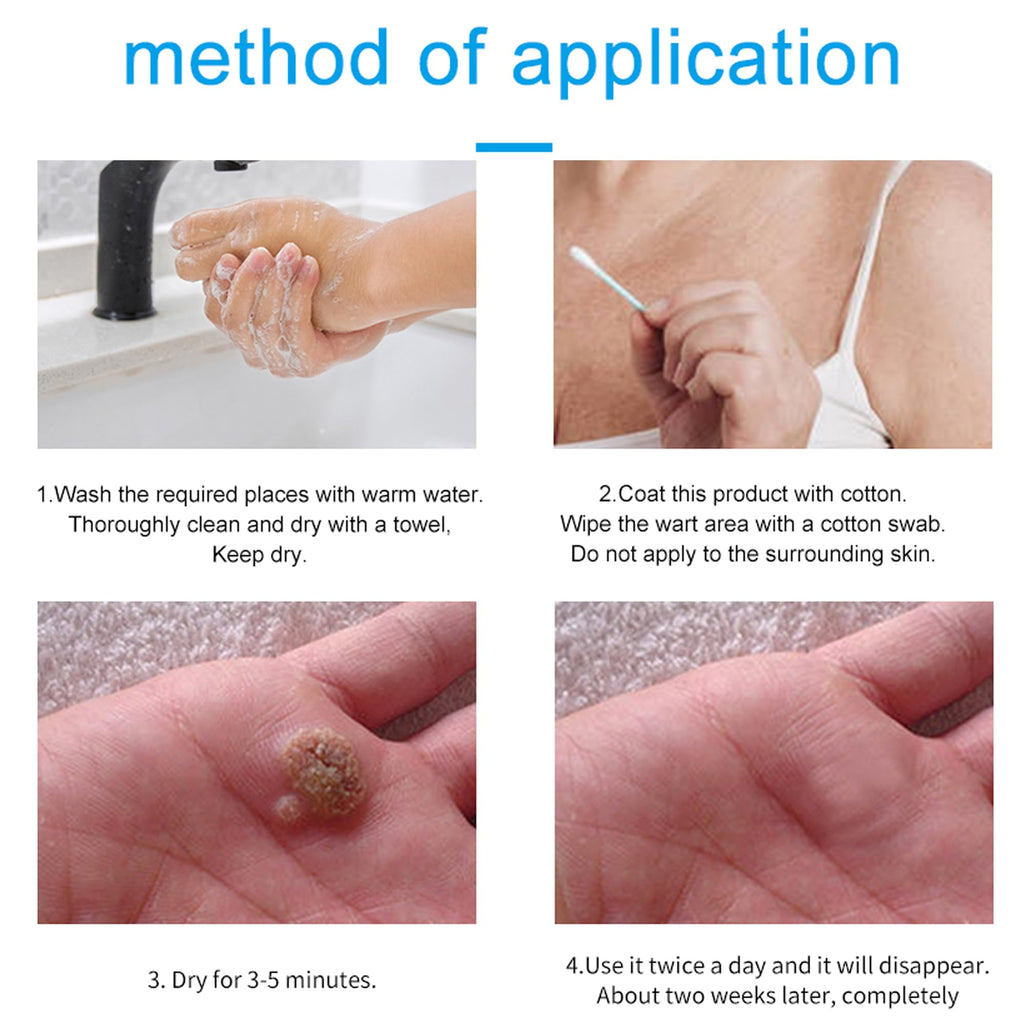 Skin-Tag-Remover, Wart Remover, Mole & Wart-Remover Liquid, Fast-Acting Skin-Tag-Remover for Tag Removal & Verruca-Treatment